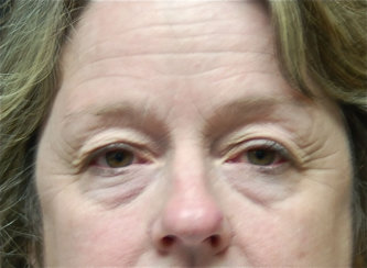 Upper and Lower Eyelid Surgery - Blepharoplasty