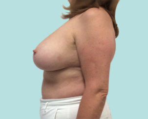 Breast Reduction, Breast Lift 