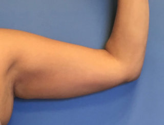 Liposuction of the Arms