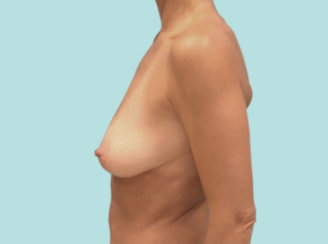 Breast Lift, Breast Reduction