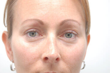 Eyelid Surgery (Upper Blepharoplasty)