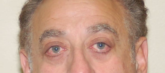 Upper & Lower Eyelid Surgery (Blepharoplasty)