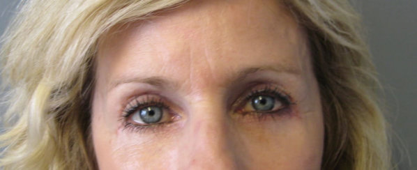 Eyelid Surgery (Blepahroplasty) & Facial Rejunevation with Deep Chemical Peel