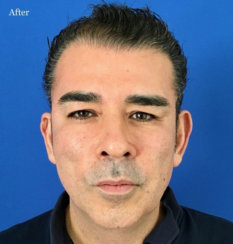 Minimally Invasive Facelift Elevation 