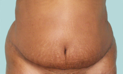 Modern Abdominoplasty