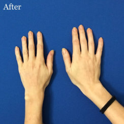 Hands Rejuvenation: Fat Transfer to Hands