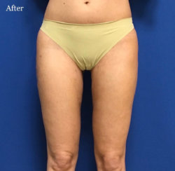 Circumferential Liposuction of Hips & Thighs