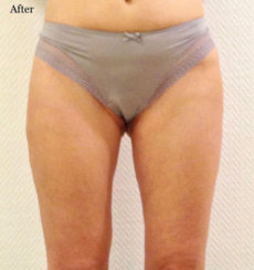 Getting Rid of Saddlebags (Outer Thighs) & Inner Thighs
