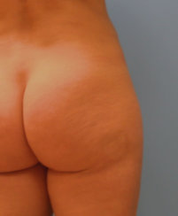 Buttock Correction of Dimples and Cellulite