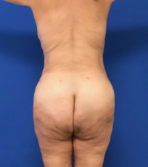 Modern Abdominoplasty & Body Contouring