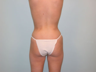 Liposuction & Modern Tummy Tuck