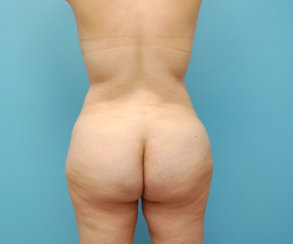 Liposuction of Abdomen, Flanks, Back and Fat Transfer to Hips