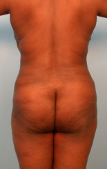Liposuction of the Back