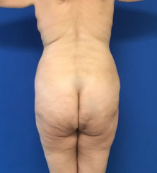 Modern Abdominoplasty & Body Contouring