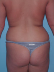 Liposuction & Modern Tummy Tuck