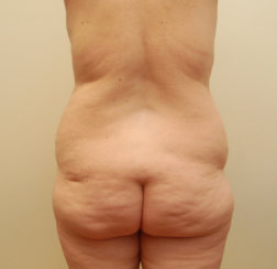 Mommy Makeover: Modern Abdominoplasty, Liposuction & Breast Lift
