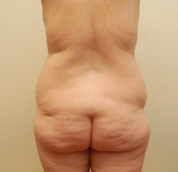 Liposuction 360