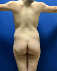 Brazilian Butt Lift & Body Contouring