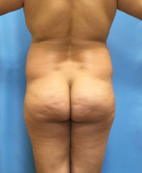 Brazilian Butt Lift & Body Contouring