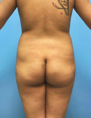Brazilian Butt Lift and Body Contouring