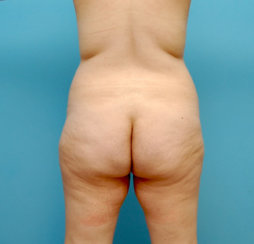 Liposuction of Abdomen, Flanks, Back and Fat Transfer to Hips