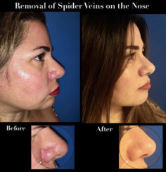 Permanent Removal of Spider Veins on the Nose