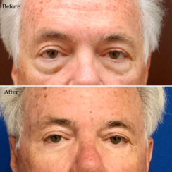 Blepharoplasty: Lower Eyelid Surgery