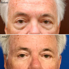 Blepharoplasty: Lower Eyelid Surgery