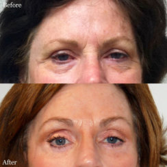 Facelift, Neck Lift, Brow Lift & Upper and Lower Eyelids Surgery