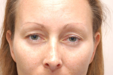 Eyelid Surgery (Upper Blepharoplasty)