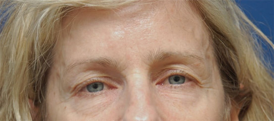 Eyelid Surgery (Blepahroplasty) & Facial Rejunevation with Deep Chemical Peel