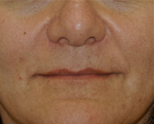 Correction of Facial Wrinkles with Restylane