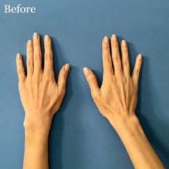 Hands Rejuvenation: Fat Transfer to Hands