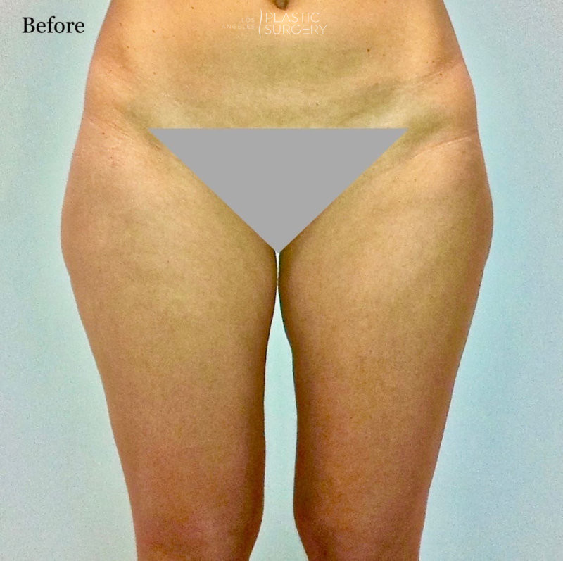 🥇 Thigh Liposuction - Los Angeles Plastic Surgery