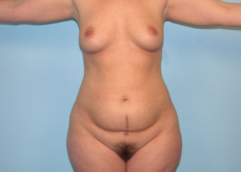 Mommy Makeover: Modern Abdominoplasty & Breast Augmentation