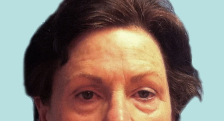 Facelift, Neck Lift, Brow Lift & Upper and Lower Eyelids Surgery