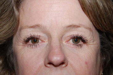 Upper and Lower Eyelid Surgery - Blepharoplasty