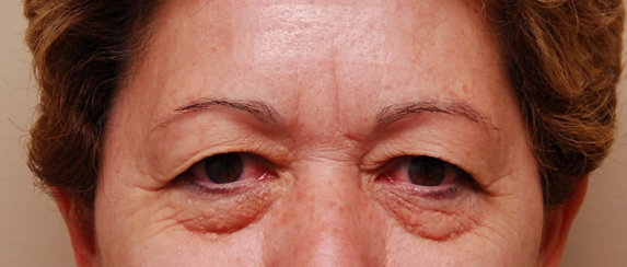 Upper and Lower Eyelid Surgery (Upper and Lower Blepharoplasty)