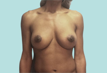 Breast Implant Removal & Replacement, 450cc to 700cc