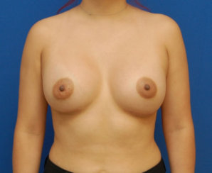 Breast Augmentation: Breast Asymmetry Correction