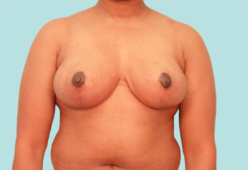 Breast Reduction, Breast Lift