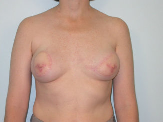 Breast Reconstruction  