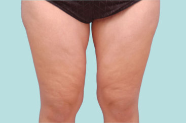 Medial Thigh Lift: Addressing Skin Laxity of Inner Thighs