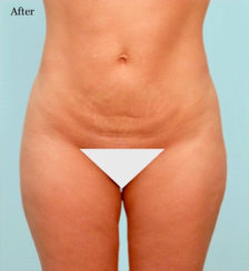 Liposuction of Saddlebags (Outer Thighs) & Inner Thighs