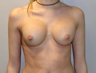 Breast Augmentation Revision/Correction