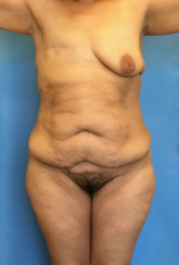Breast Reconstruction & Abdominoplasty