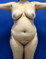 Mommy Makeover: Standard Abdominoplasty & Liposuction 360
