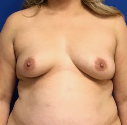 Breast Lift without External Cuts, Correction of Breast Asymmetry, Breast Augmentation