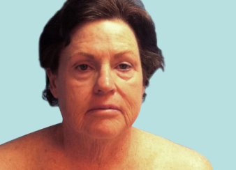 Facelift, Neck Lift, Brow Lift & Upper and Lower Eyelids Surgery