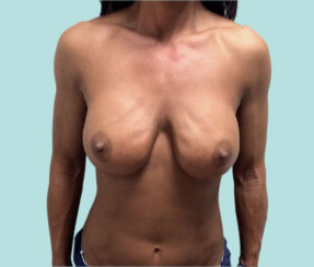 Breast Implant Revision: Correction Of Breast Implant Rippling & Cleavage Creation
